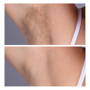 hair removal